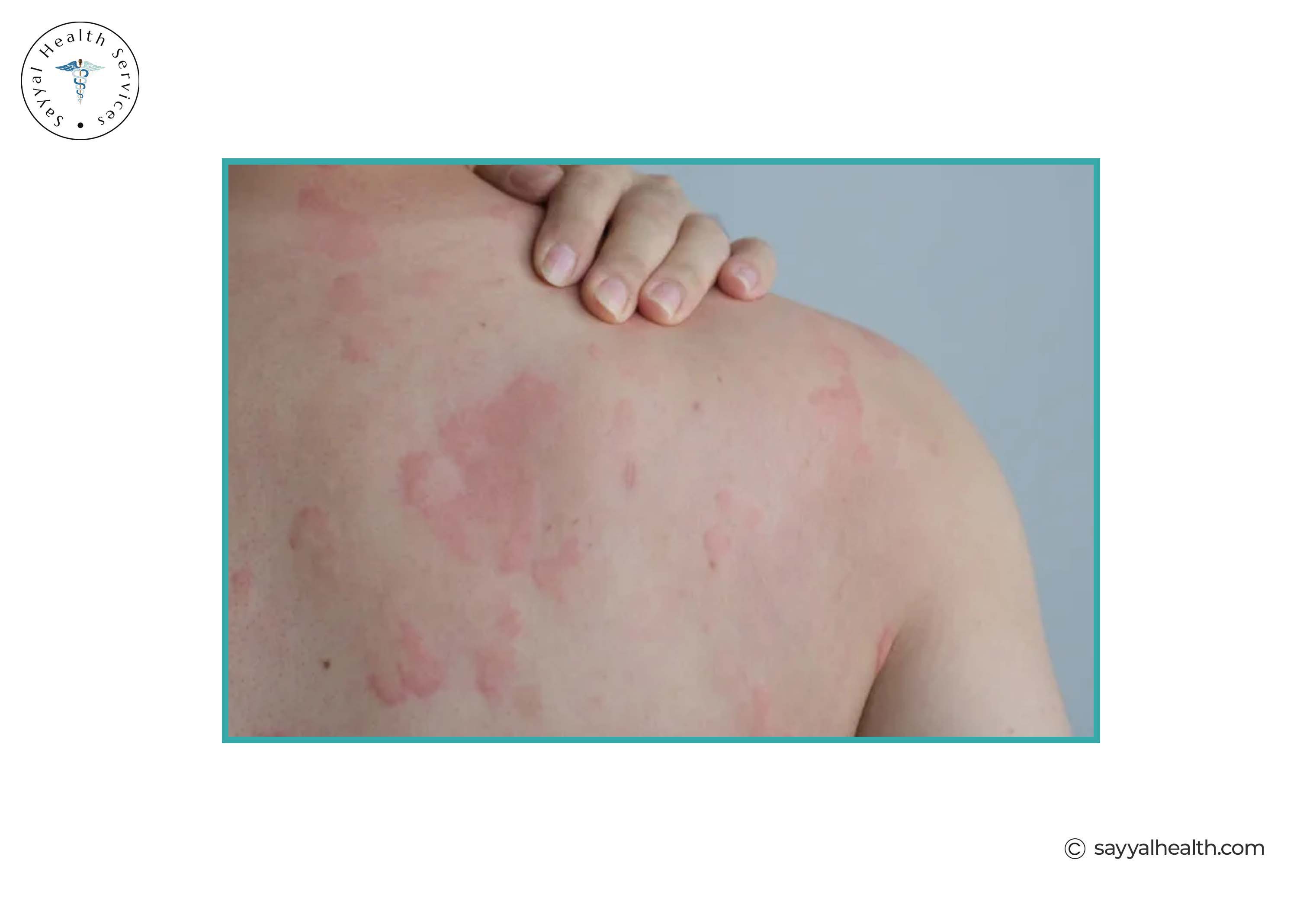 Red skin rash and irritation on shoulder and upper back